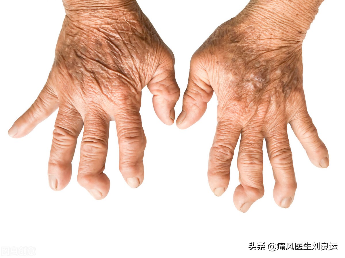 痛风会在脚趾和膝关节同时发作吗,痛风发作从脚趾头到脚踝又到膝盖