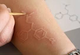 人工荨麻疹皮肤划痕症怎么治,人工荨麻疹皮肤划痕症怎么治疗