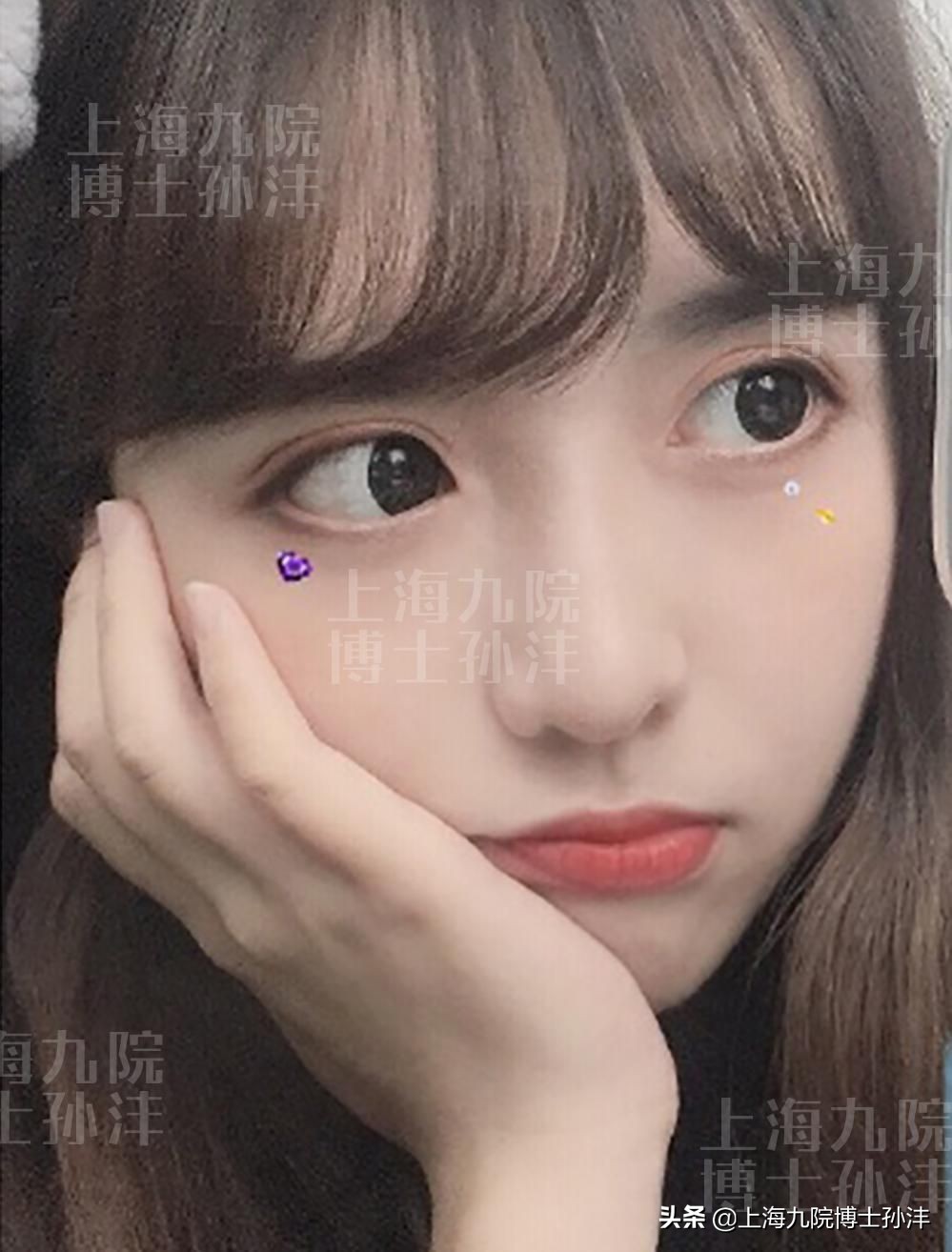 平行双眼皮眼皮薄,多眼皮做双眼皮手术埋线