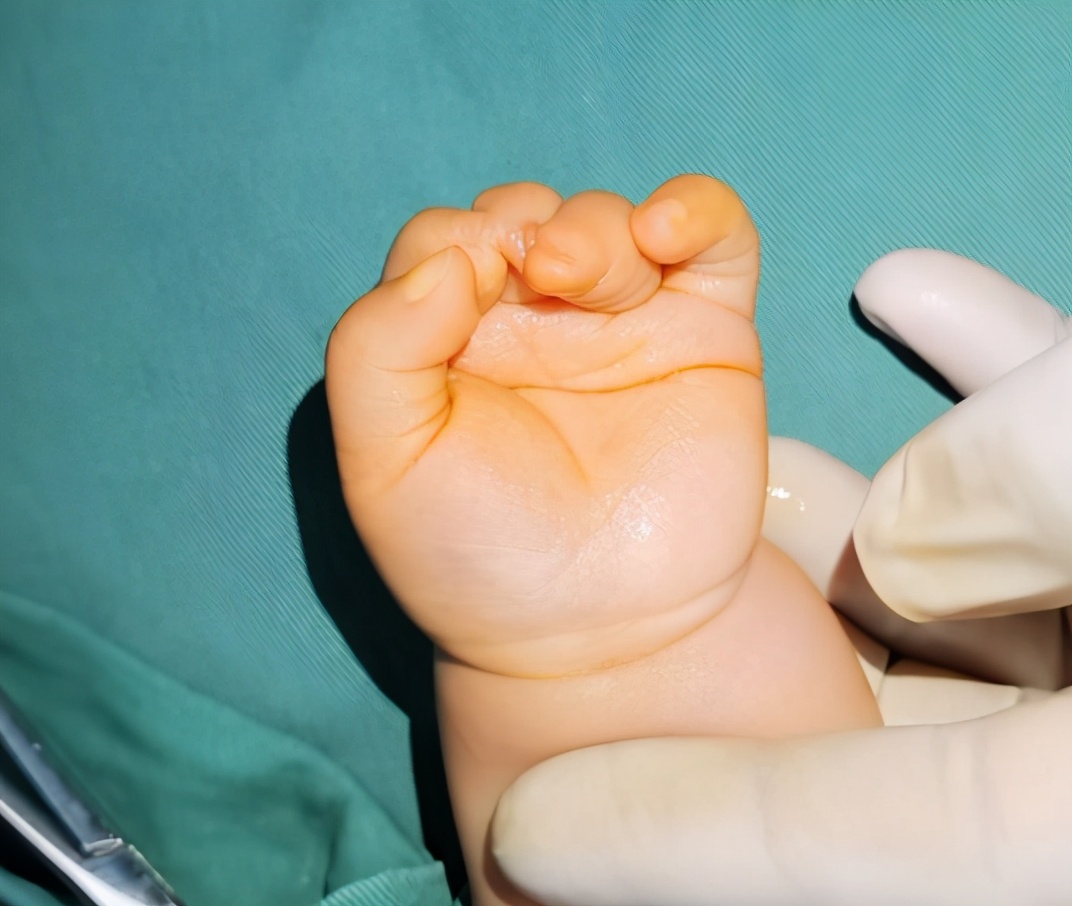 并指畸形免植皮案例,并指畸形