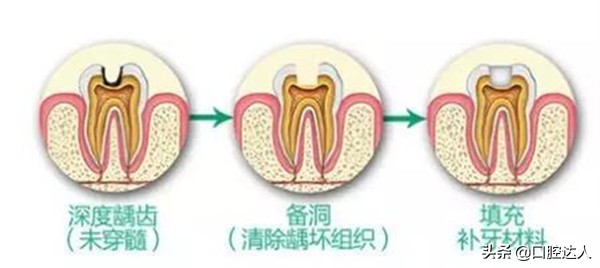 不补牙齿有问题吗,不补牙齿后牙齿会怎样