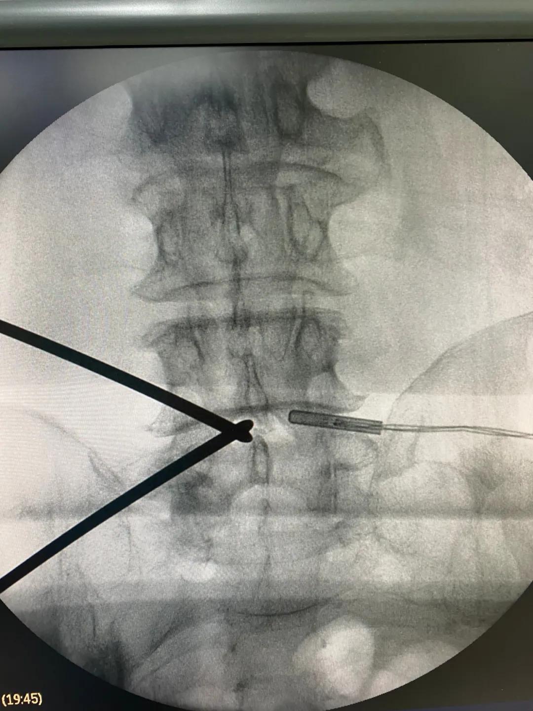 南通首例！海安市中医院骨伤科成功开展UBE技术治疗腰腿痛
