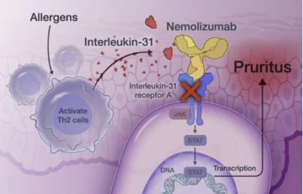 皮炎湿疹口服特效药,皮炎湿疹特效药试用装