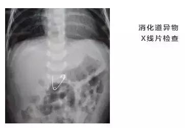 喉管长期被胃酸腐蚀会怎么样,小孩喉管被腐蚀