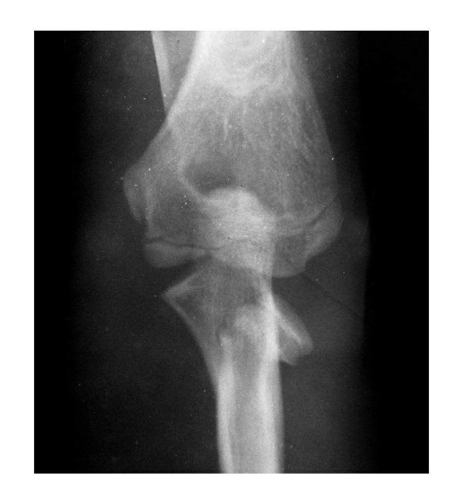 青少年肘部损伤最常见的是,肘部桡神经损伤的临床表现