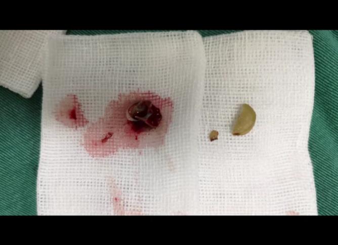 11岁男孩反复发烧退不下去怎么办,14岁男孩反复发烧去医院检查