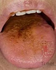 黄苔怎么造成的,黄苔一定是实热吗