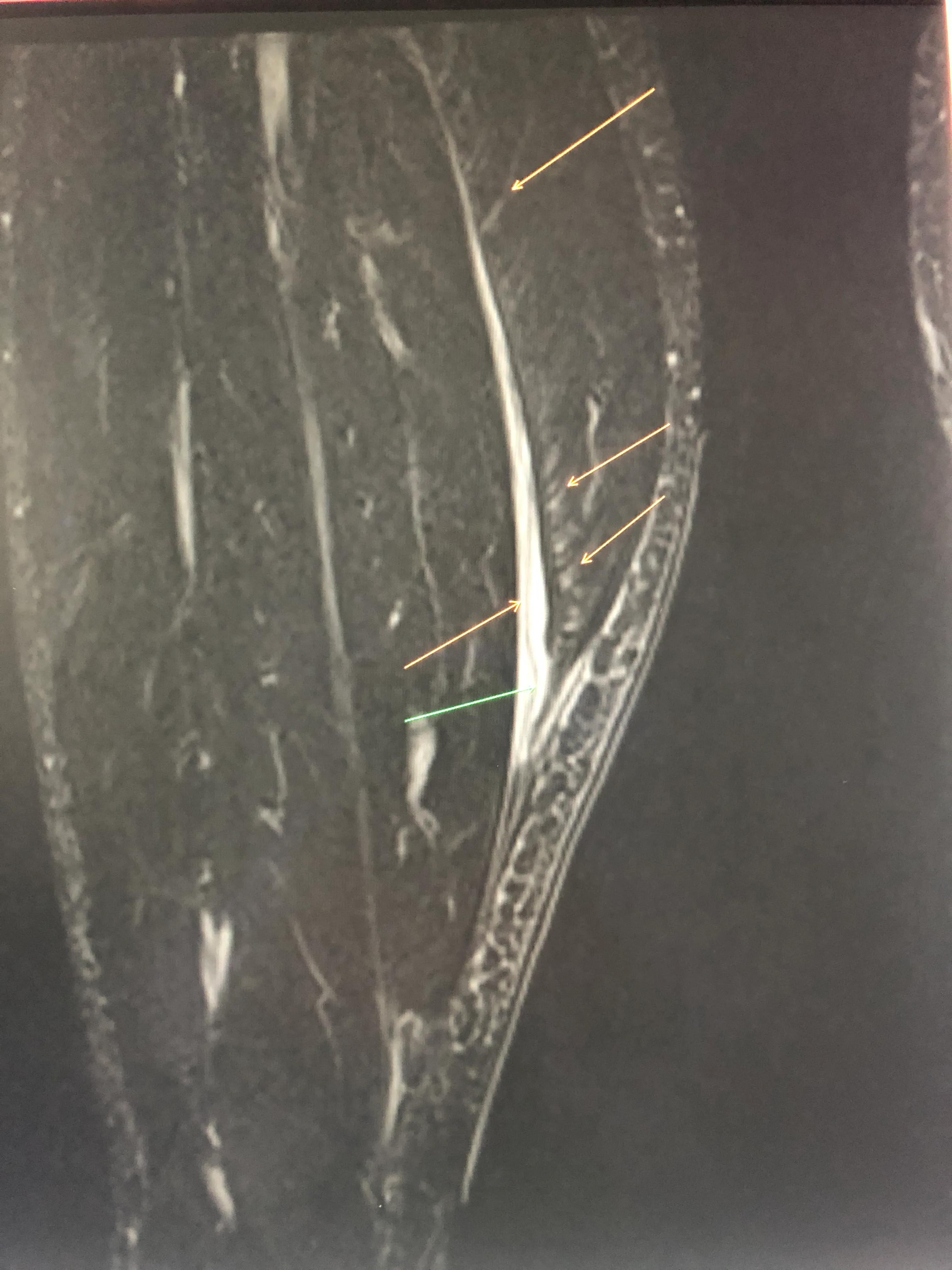 网球腿,网球肘肌腱撕裂