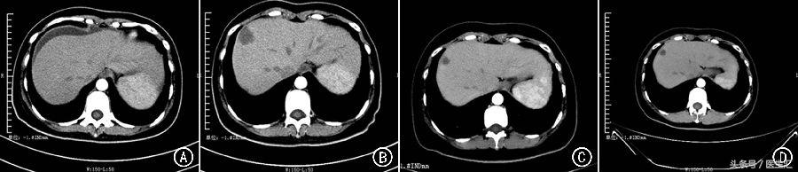 腹胀用莫沙必利,依维莫司有何副作用