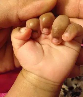 手指节皮肤发黑怎么回事啊,奇怪的手指图片