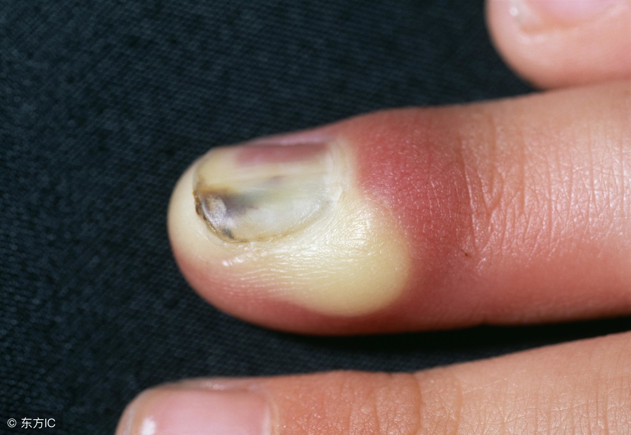 得了甲沟炎最好的处理办法,得了甲沟炎怎么正确处理