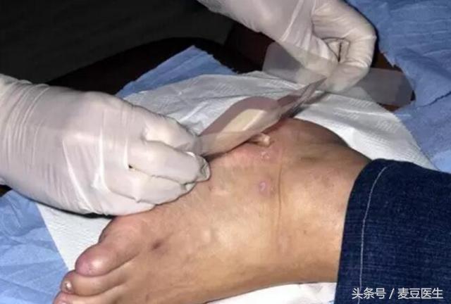 为什么糖尿病脚底会有洞,脚上的洞