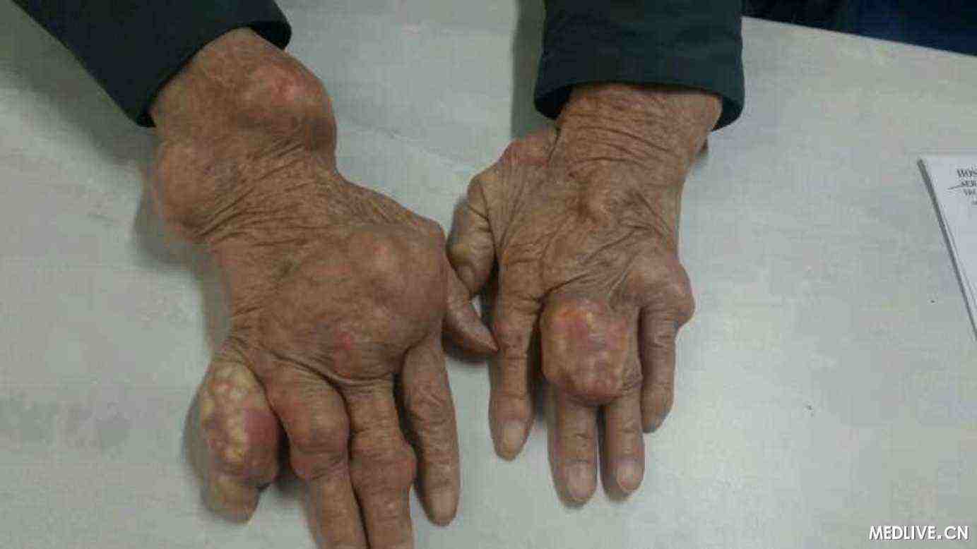 痛风发病的原因和治疗,一文读懂痛风