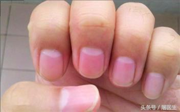 手指甲半月形代表什么,手指甲月牙处发黑是什么原因