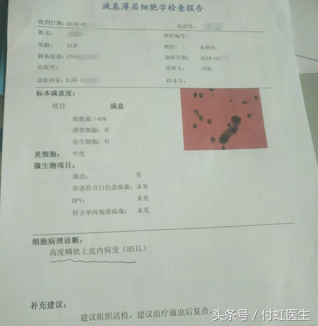 hpv18阳性tct低度病变是宫颈癌吗,hpv18阳性tct高度病变是宫颈癌吗