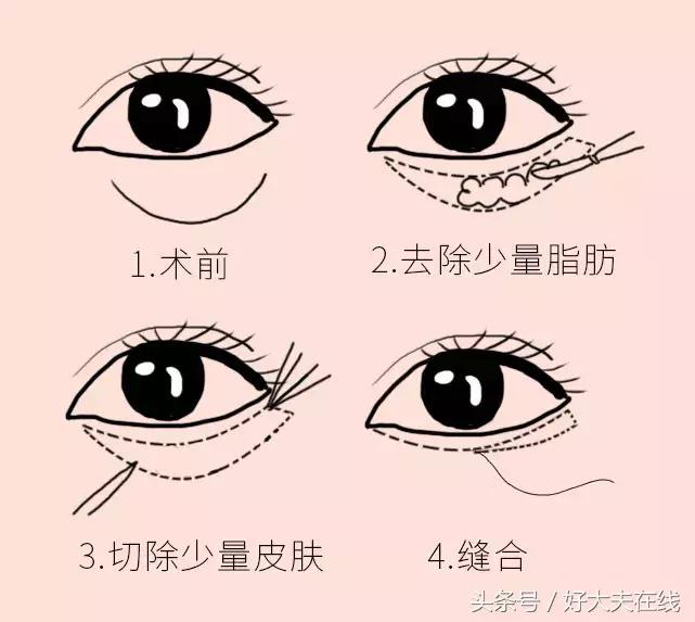 眼袋泪沟怎么去除男生,眼袋和泪沟怎么去除要多少钱