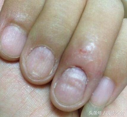 指甲变脆有竖纹怎么办,指甲变脆容易折断是什么原因