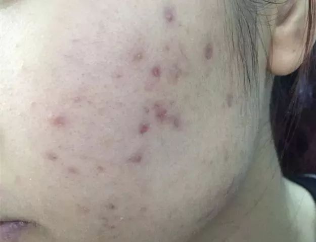 祛痘和祛痘印最好的方法,祛痘和祛痘印的方法一样吗