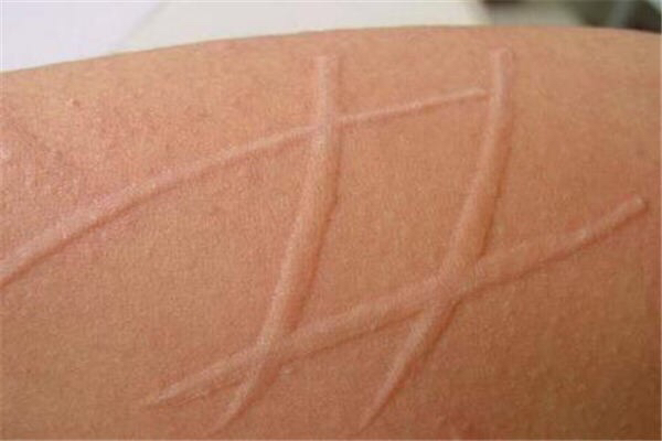 荨麻疹皮肤发红灼热刺痛,荨麻疹奇痒难忍需要打点滴吗