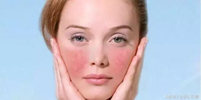 春季脸部红血丝明显,脸上有血丝怎么解决