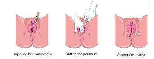 侧切的10大忌,顺产的10大忌