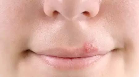 疱疹病毒真的会让胎儿畸形吗,你真的了解病毒病吗