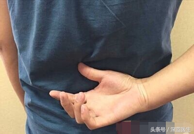 恶性黑色素瘤有活二十年的吗,恶性黑色素瘤为什么致死