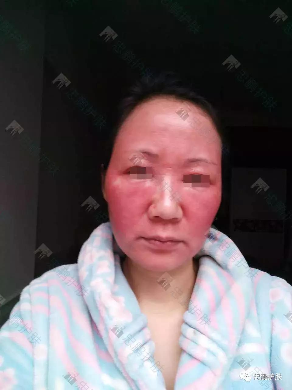 激素脸发红发热脱皮怎么办呢,激素脸为什么会扩散到脖子上代谢