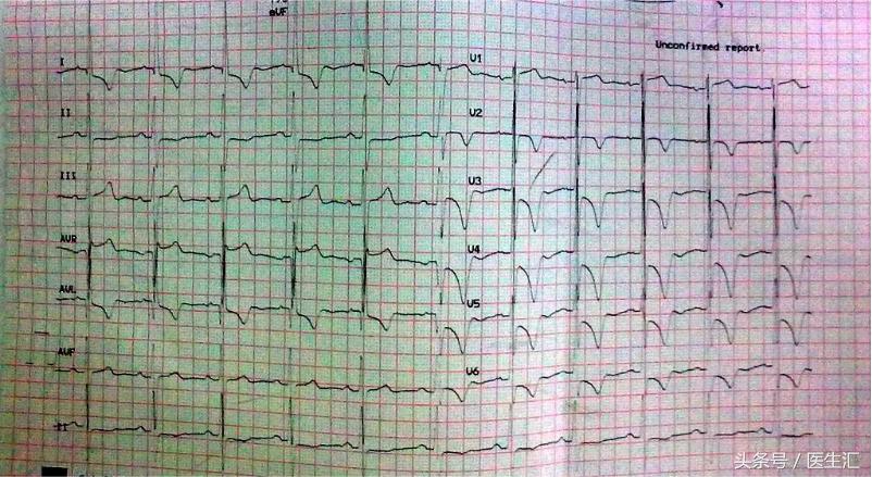 高龄心衰患者怎么做降压治疗?