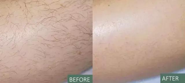 一秒脱毛,如何在一分钟内脱毛