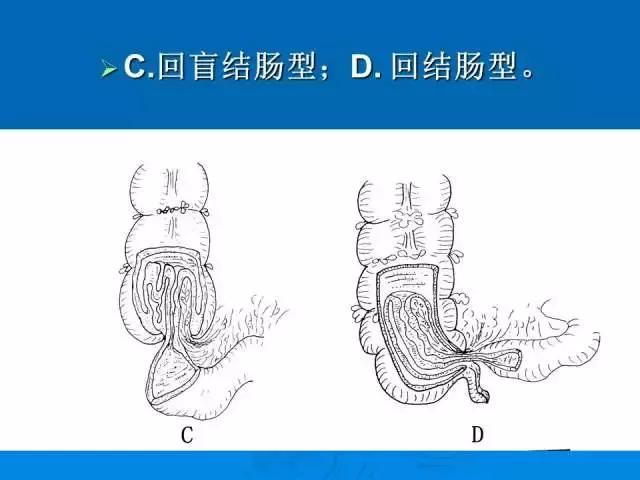 小儿肠套叠空气灌肠需要注意事项,儿童肠套叠空气灌肠要不要住院
