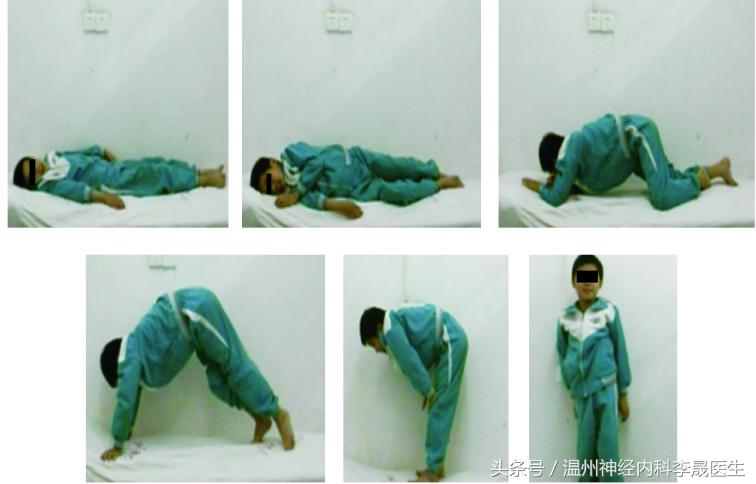 良性肌营养不良自愈的奇迹,进行性肌营养不良分型图表