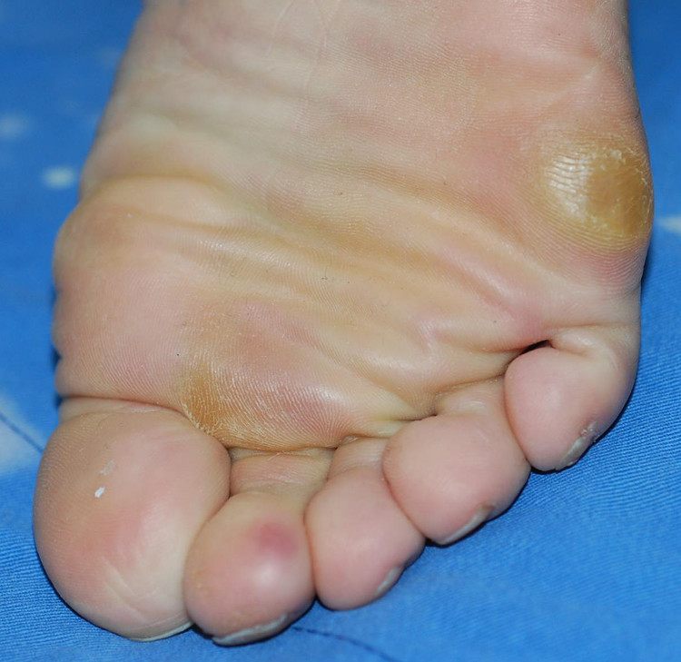 长期光脚走路会不会使脚下长老茧,脚下为什么长老茧
