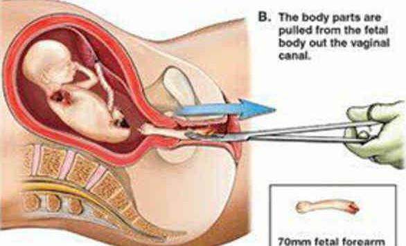 孩子被打掉是什么过程,孩子是怎样被打掉的