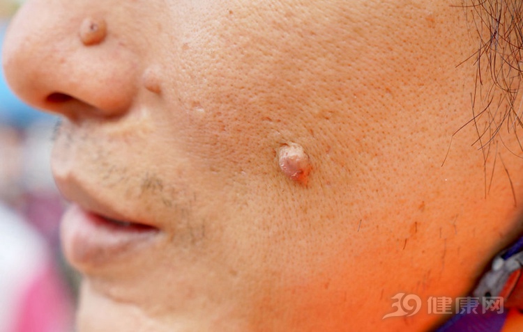 守住6道防线远离糖尿病肾病,一定要警惕皮肤癌