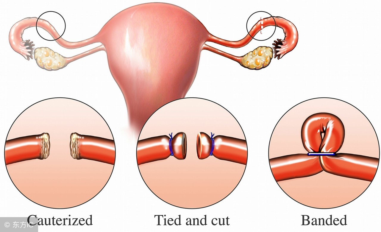 结扎，到底是男的好还是女的好了！