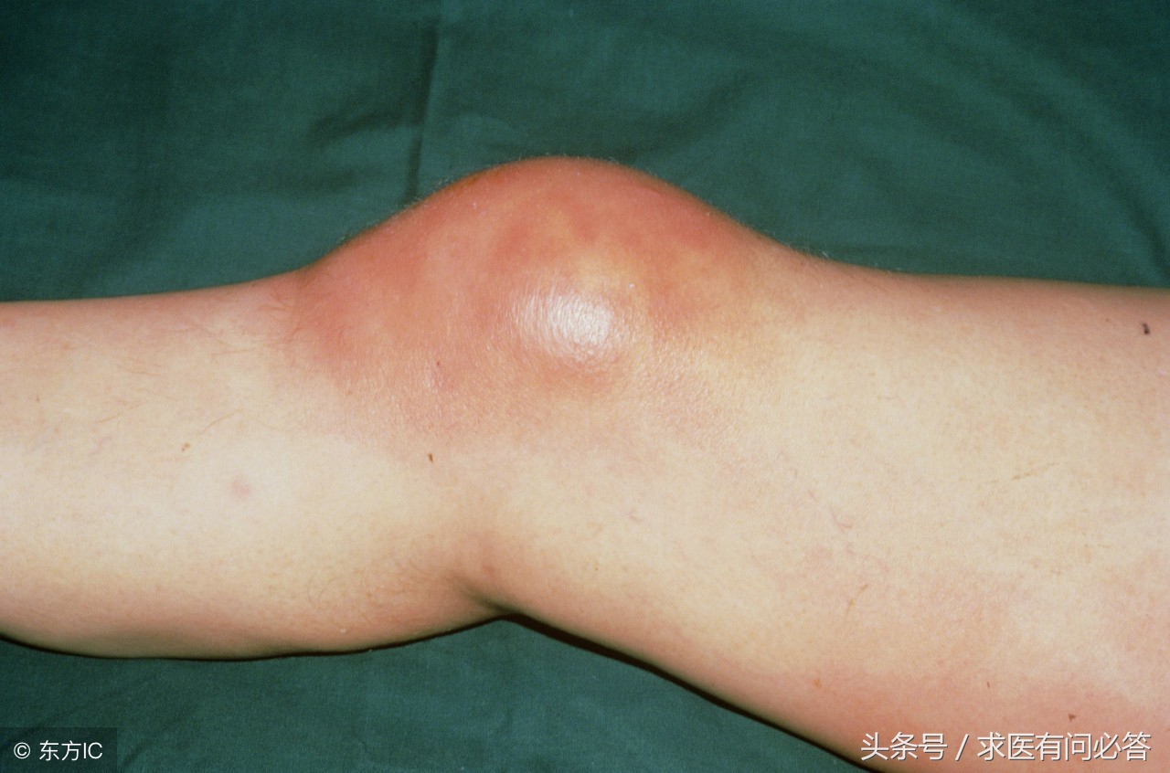 滑膜炎饮食上需要注意什么,关节炎和滑膜炎饮食吃什么好