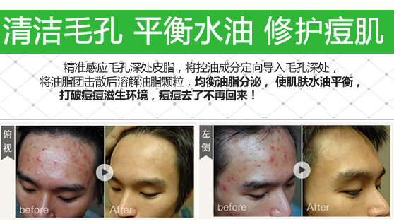 男生祛痘痘和痘印最有效的方法,男生如何祛痘痘和痘印小妙招