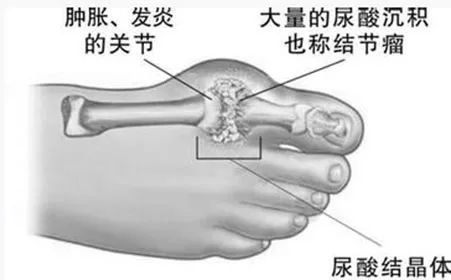 痛风疼起来真要命,痛风痛起来真要命原因
