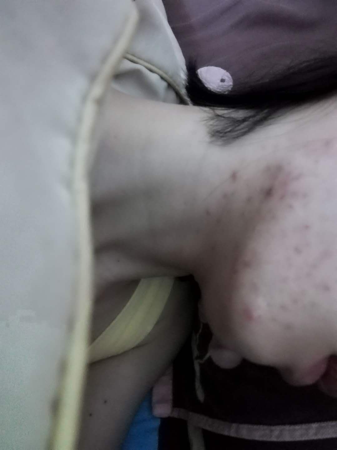 十年战痘的真实经历,十年抗痘血泪史真实经历