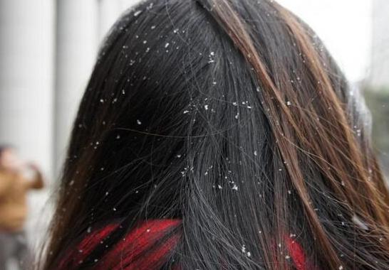 春季头上痒有头皮屑怎么办,头痒长头皮屑用什么方法治疗