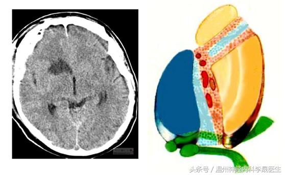 张景明教授讲脑中风后遗症,李医生讲中风视频全集