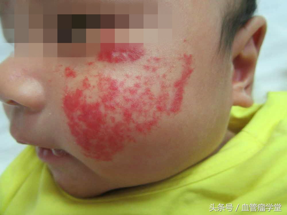 皮肤血管瘤治疗方法和优缺点,儿童激光治疗血管瘤优缺点