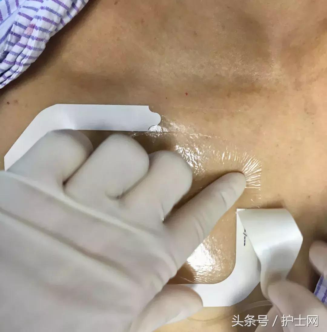 输液港扎针最全示范,输液港拔针的正确方法视频教程