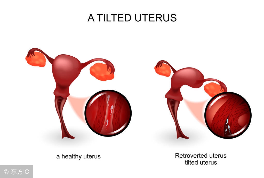 宫颈炎常见两种病原体,宫颈炎性疾病怎么预防