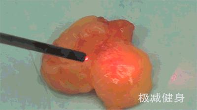 减肥抽脂的过程是怎样的,抽脂减肥的危害亲身经历