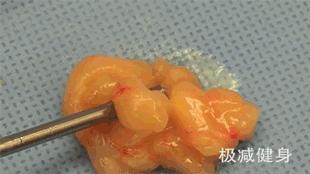 抽脂减肥的五大误区,减肥抽脂的过程是怎样的