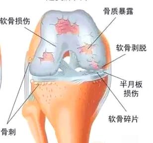 不伤膝盖运动的正确方法,怎么运动减少膝盖软骨磨损