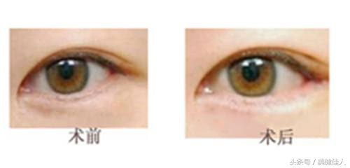 眼角开的十分大好看吗,眼角开大的眼睛