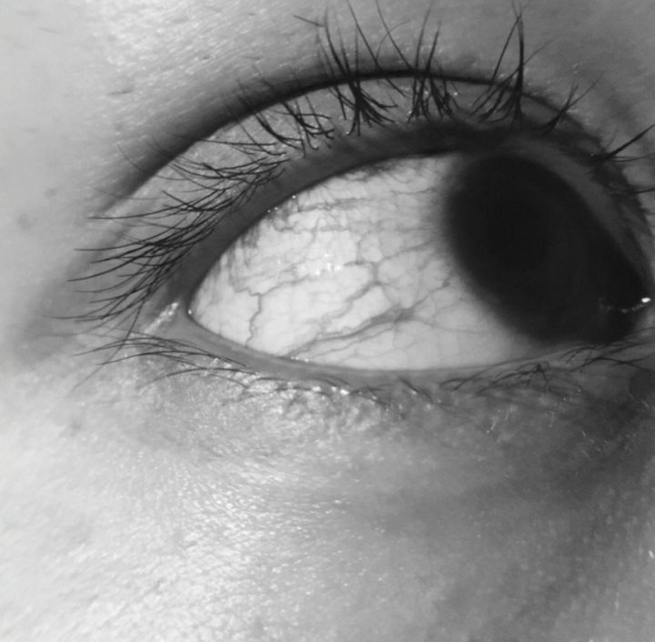 眼袋黑眼圈脂肪粒的消除方法,眼袋黑眼圈最有效的去除方法17岁